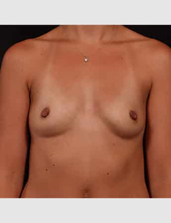Before Image: Breast Augmentation - front