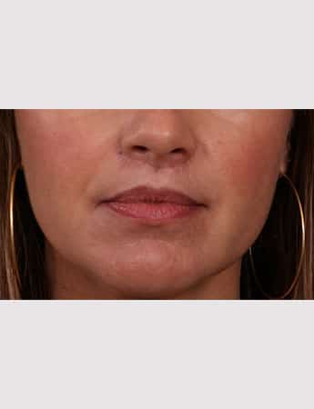 After Image: Lip Lift - front