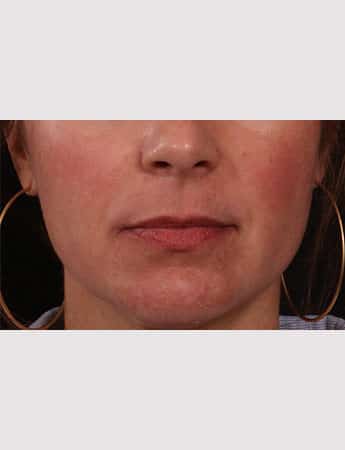 Before Image: Lip Lift - front