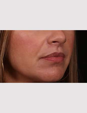 After Image: Lip Lift - right-front-oblique
