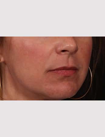 Before Image: Lip Lift - right-front-oblique
