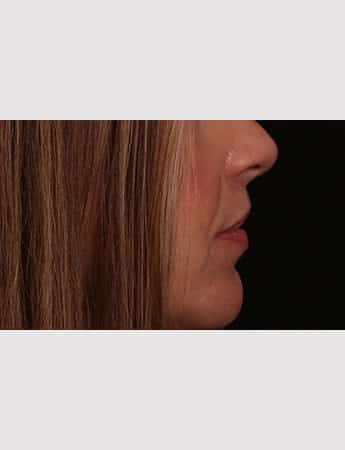 After Image: Lip Lift - right-side