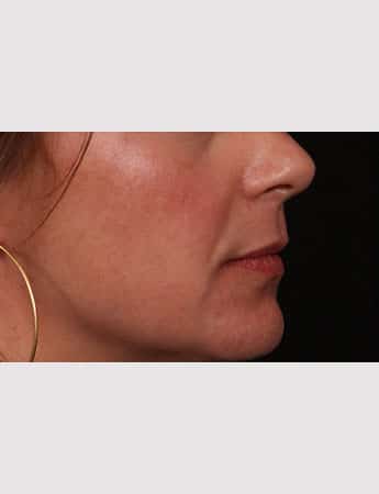 Before Image: Lip Lift - right-side