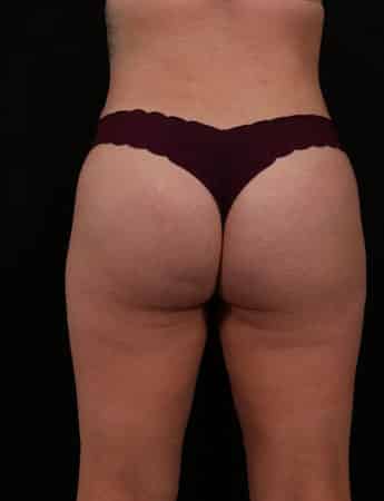 After Image: Brazilian Butt Lift - back