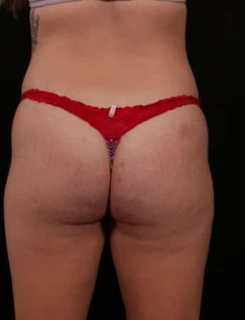Before Image: Brazilian Butt Lift - back