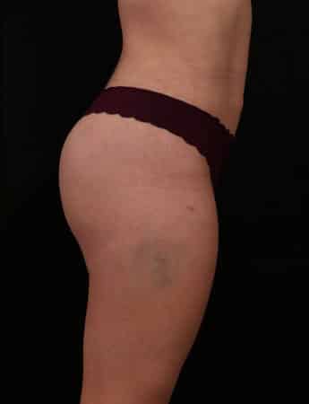 After Image: Brazilian Butt Lift - right-side