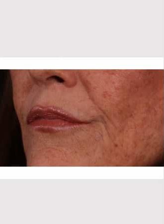 After Image: Lip Lift - left-front-oblique