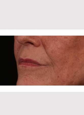 Before Image: Lip Lift - left-front-oblique