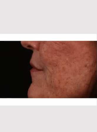 After Image: Lip Lift - left-side