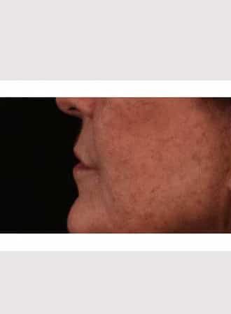 Before Image: Lip Lift - left-side