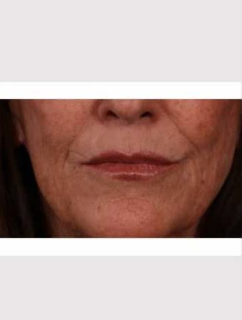 After Image: Lip Lift - front
