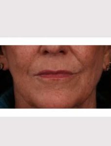 Lip Lift