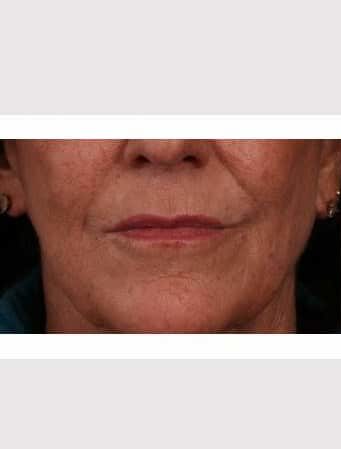 Before Image: Lip Lift - front