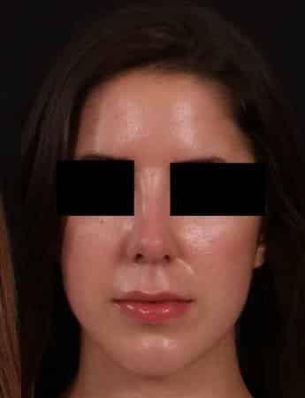 After Image: Rhinoplasty - front