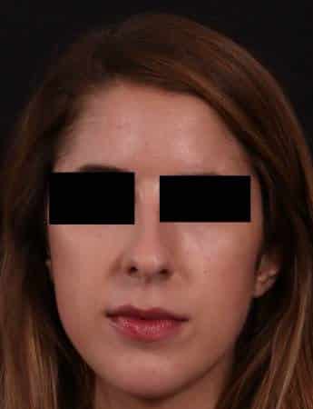 Before Image: Rhinoplasty - front