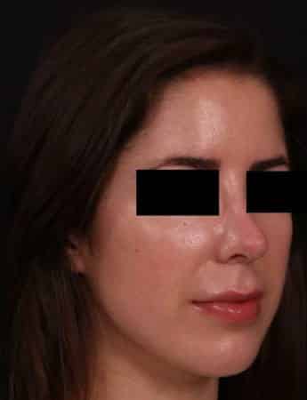 After Image: Rhinoplasty - right-front-oblique
