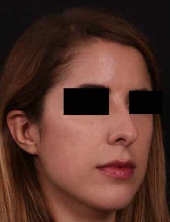 Before Image: Rhinoplasty - right-front-oblique