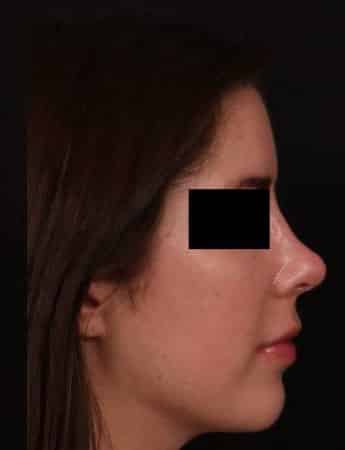 After Image: Rhinoplasty - right-side