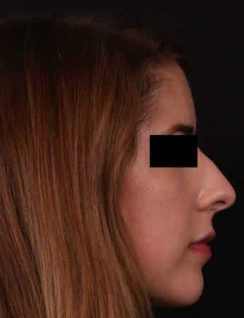 Before Image: Rhinoplasty - right-side