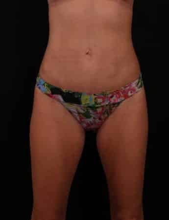 After Image: Mini Tummy Tuck (Abdominoplasty) - front