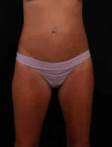 Mini Tummy Tuck (Abdominoplasty)