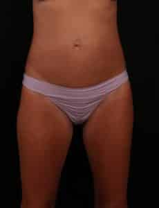 Before Image: Mini Tummy Tuck (Abdominoplasty)
