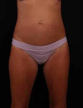 Before Image: Mini Tummy Tuck (Abdominoplasty) - front