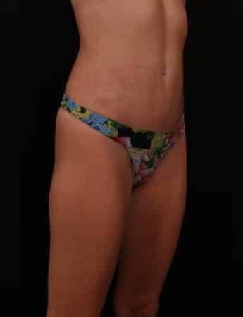 After Image: Mini Tummy Tuck (Abdominoplasty) - right-front-oblique