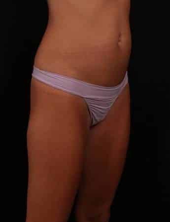 Before Image: Mini Tummy Tuck (Abdominoplasty) - right-front-oblique