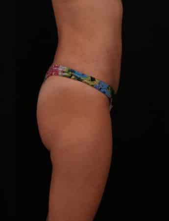 After Image: Mini Tummy Tuck (Abdominoplasty) - right-side