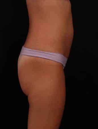 Before Image: Mini Tummy Tuck (Abdominoplasty) - right-side