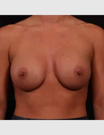 After Image: Breast Augmentation - front