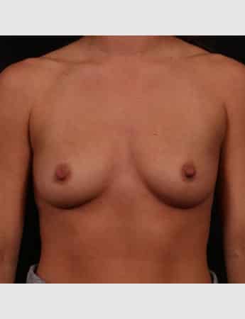 Before Image: Breast Augmentation - front