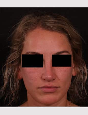 After Image: Rhinoplasty - front