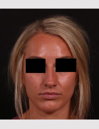 Before Image: Rhinoplasty - front