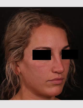 After Image: Rhinoplasty - right-front-oblique