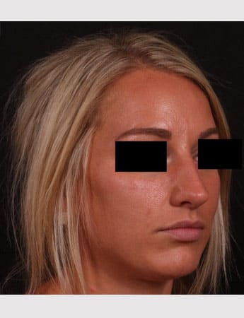 Before Image: Rhinoplasty - right-front-oblique