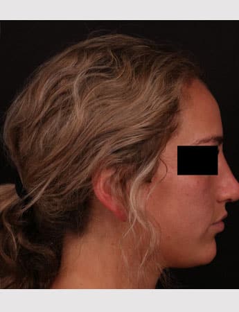 After Image: Rhinoplasty - right-side