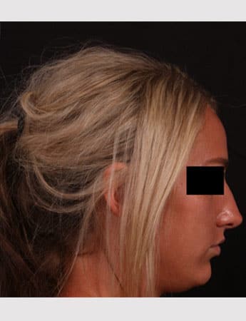 Before Image: Rhinoplasty - right-side
