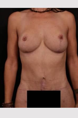 After Image: Mommy Makeover - front