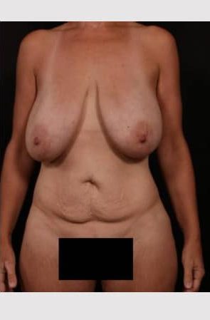 Before Image: Mommy Makeover - front