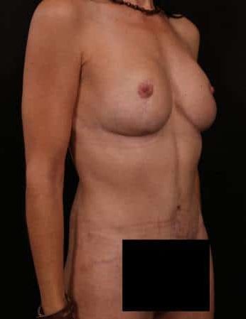 After Image: Mommy Makeover - right-front-oblique