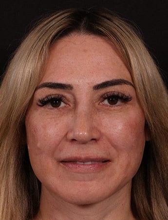 After Image: Rhinoplasty - front