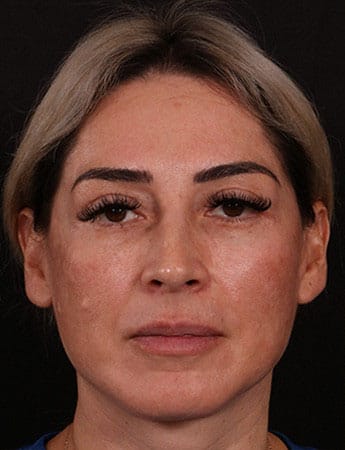 Before Image: Rhinoplasty - front