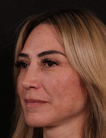 After Image: Rhinoplasty - left-front-oblique