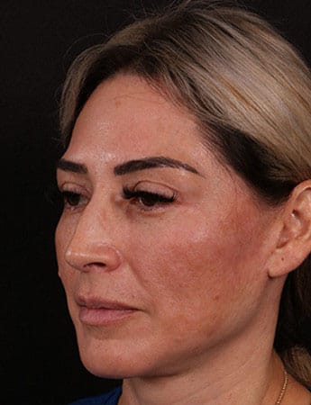 Before Image: Rhinoplasty - left-front-oblique