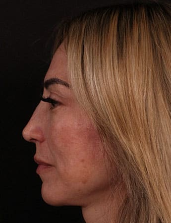 After Image: Rhinoplasty - left-side