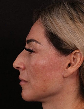 Before Image: Rhinoplasty - left-side