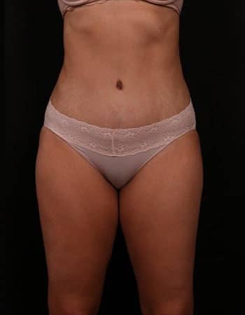 After Image: Tummy Tuck (Abdominoplasty) - front