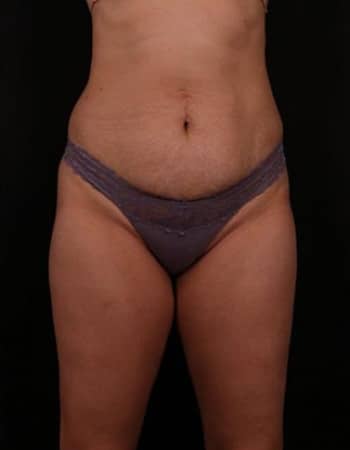 Before Image: Tummy Tuck (Abdominoplasty) - front